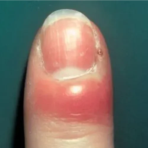 panadizo-clinica-cirugia-cosido